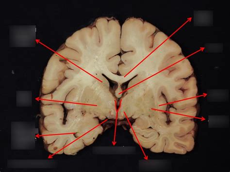 Corte Sagital Cerebro Wise Impressed