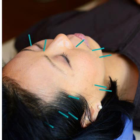 Acupuncture: Ancient Effective Healing - Wellness@TheClinic