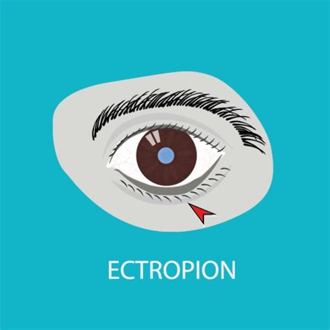 Entropion Outward Turning Eyelid Treatment | Providence Eye