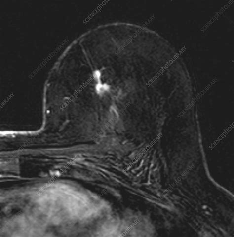 Spiculated Nodule Mri Scan Stock Image C058 4537 Science Photo Library