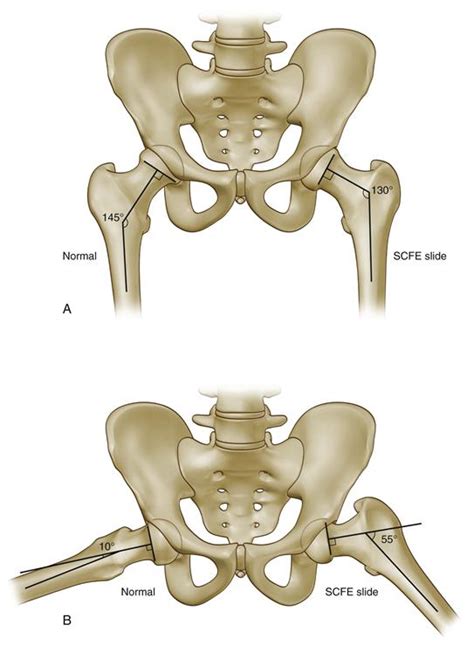 Slipped Capital Femoral Epiphysis | Musculoskeletal Key