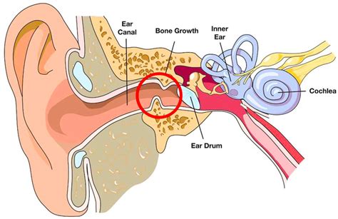 What is Surfer's Ear?