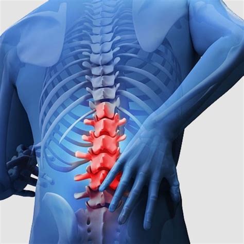 Lumbar Spondylosis Images