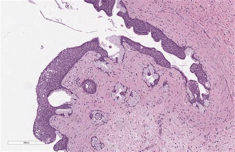 Michigan Pathology On Twitter A Bartholin Cyst Transitional