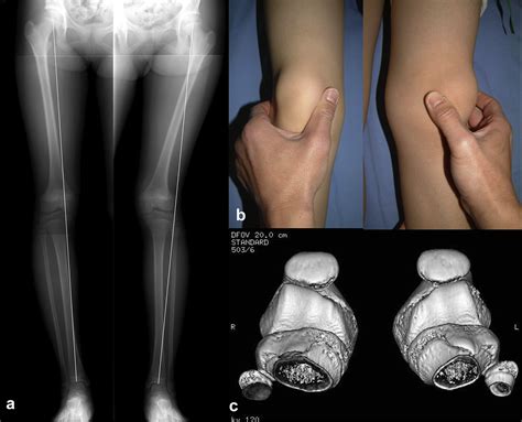 Recurrent Patellar Dislocation With Spontaneous Valgus Knee Deformity