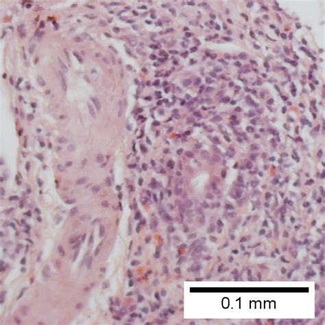 Primary Biliary Cirrhosis Libre Pathology