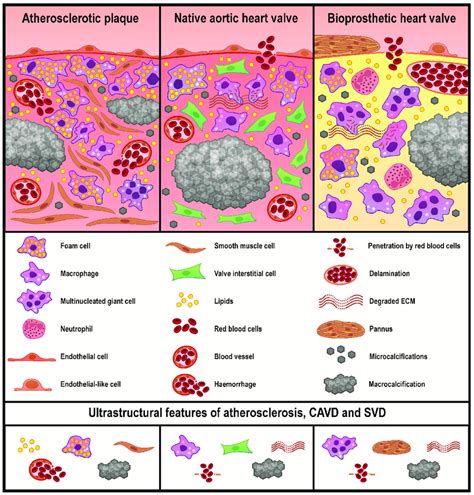 Common And Unique Ultrastructural Features Of Atherosclerotic Plaques