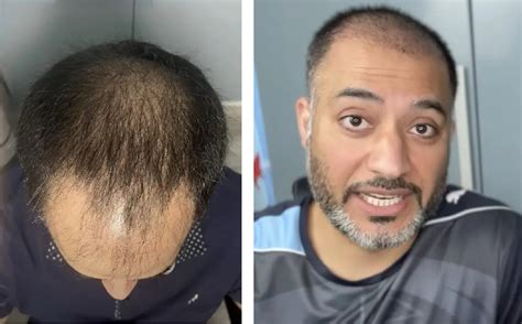 Hair Transplant After 1 Month Photos Results Side Effects