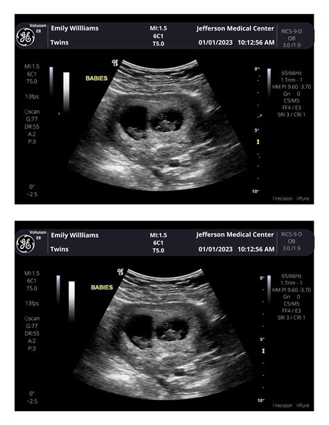 10 Weeks Pregnant Ultrasound