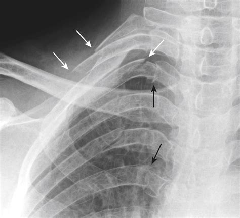 Recognizing The Imaging Findings Of Trauma To The Chest Clinical Tree