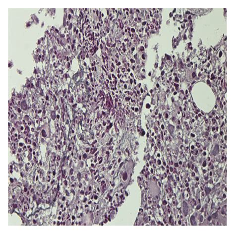 Bone Marrow A B Low Magnification Of The Bone Marrow Aspirate