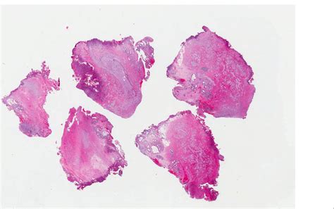 Pathology Outlines Traumatic Neuroma