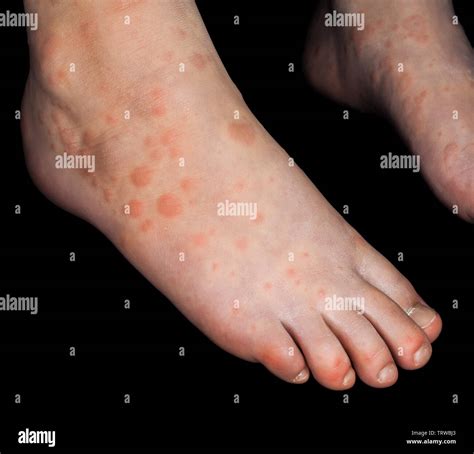 Skin Rashes On Feet