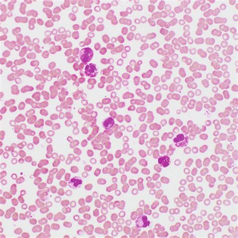 Peripheral Blood Smear Showing Many Dysplastic Eosinophils Wright S