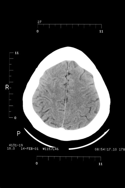 Ct scan brain stock image. Image of neural, diagnosis - 16241929