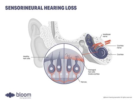 What is sensorineural hearing loss? Causes, signs & treatment