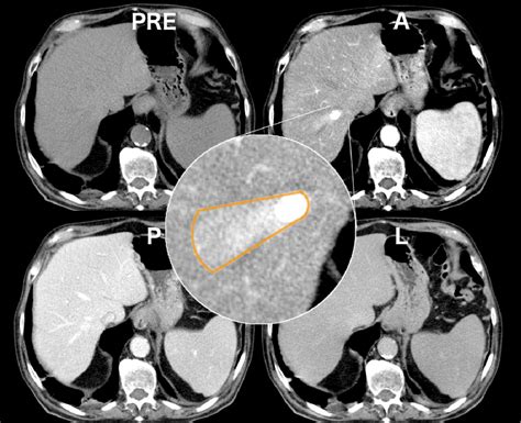 Transient Hepatic Perfusion Differences THAD THID What When Where