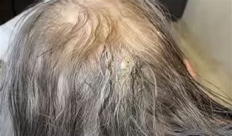 Infected Cyst on Scalp Drained : r/pimplecommunity