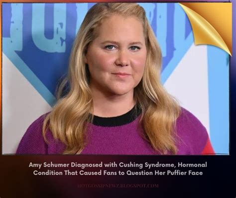 Amy Schumer Diagnosed With Cushing Syndrome Hormonal Condition That