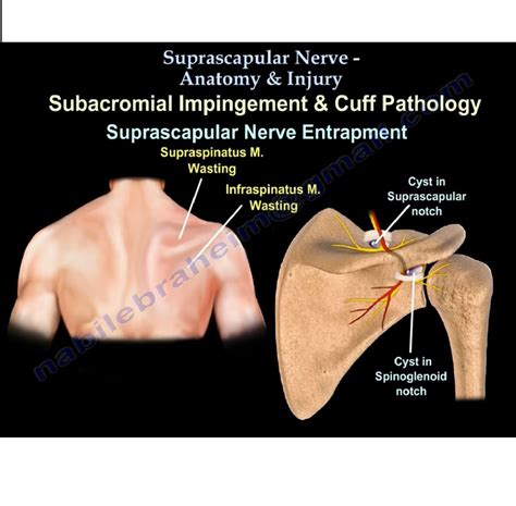 Suprascapular Nerve Anatomy OrthopaedicPrinciples 75215 Hot Sex Picture