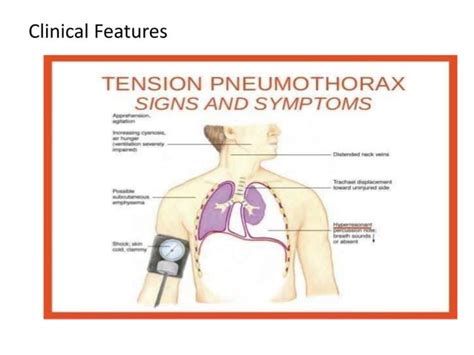 Tension Pneumothorax Pptx