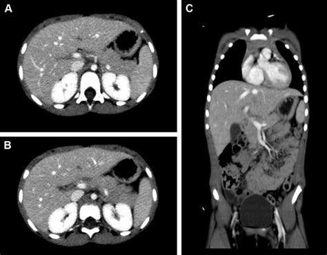 A C Postchemotherapy Contrast Enhanced Axial A And B And Coronal