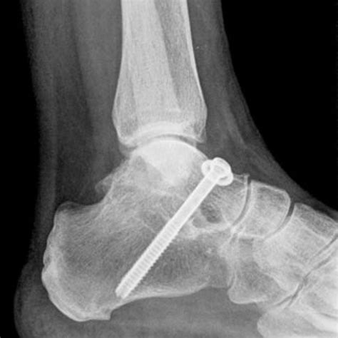 ankle-subtalar-arthrodesis- BallaratOSM | Ballarat Orthopaedics ...