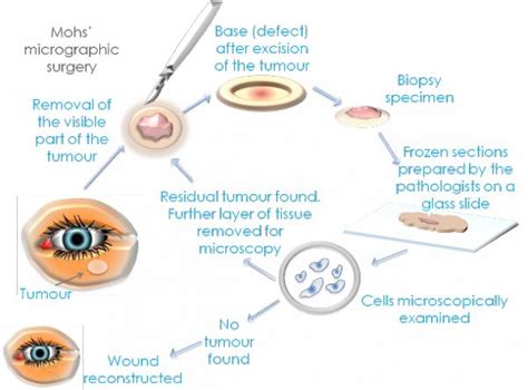 Mohs Micrographic Surgery