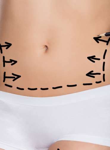 Abdominoplastie Tunisie Une Intervention Superbement Ma Tris E