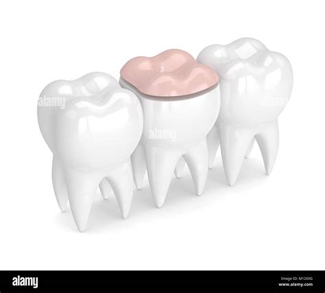 D Render Of Teeth With Dental Onlay Filling Over White Background