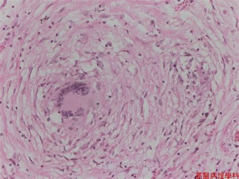 Caseating Granuloma