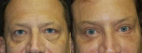 Facial Procedures Before & After Photos | Wagner and Associates