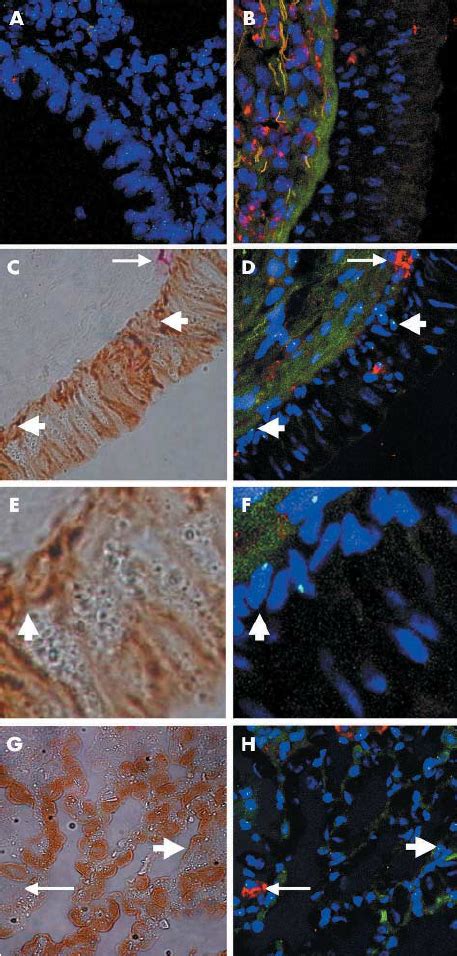 Detection Of Host Derived Epithelial Cells In Transbronchial Biopsy