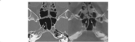 carotid canal variants   canals protrude   sphenoid sinus