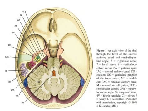 Tumors Of Middle And Inner Ear Dr Sithanandha Kumar 14 03 2016