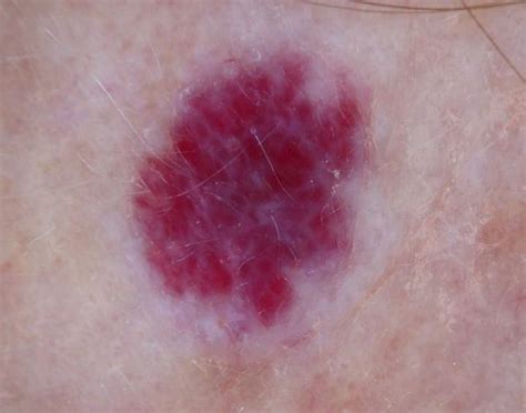 Cherry Angioma Pictures How To Remove A Cherry Angioma Dermahealth A Cherry Angioma Also