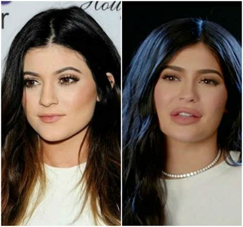 Kylie Jenner's Lips - Before and After Pictures of Her Pout