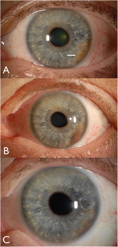 Iris Melanoma Review Of Clinical Features Risks Management And