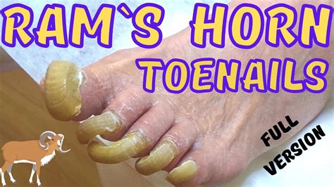 Super Long Toenails Painless Trimming Ram S Horn Toenails Youtube