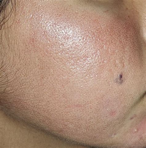 Fraxel Laser Acne scars : r/acne