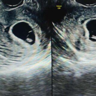 Ultrasound Confirmation of Gestational Sac in Early Pregnancy ...