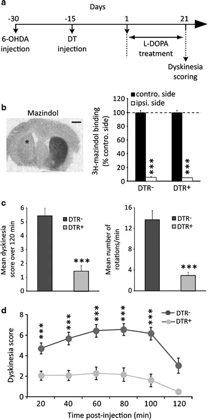 L Dopa Induced Dyskinesia Are Dramatically Reduced After Striatonigral