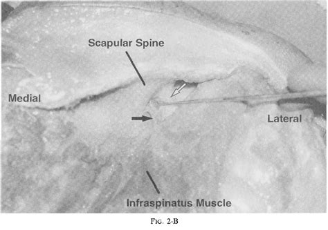 Structure Of Inferior Transverse Scapular Ligament Semantic Scholar