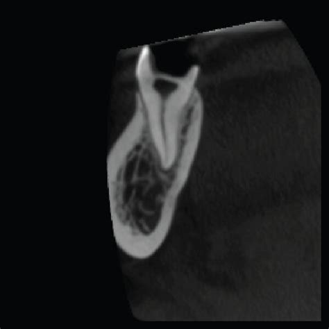 Preoperative Radiographic Assessment A Straight On And B Angulated