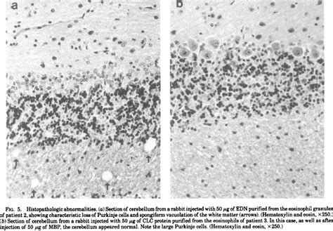 Histopathologic Changes On Light Microscopy The Histo Logic