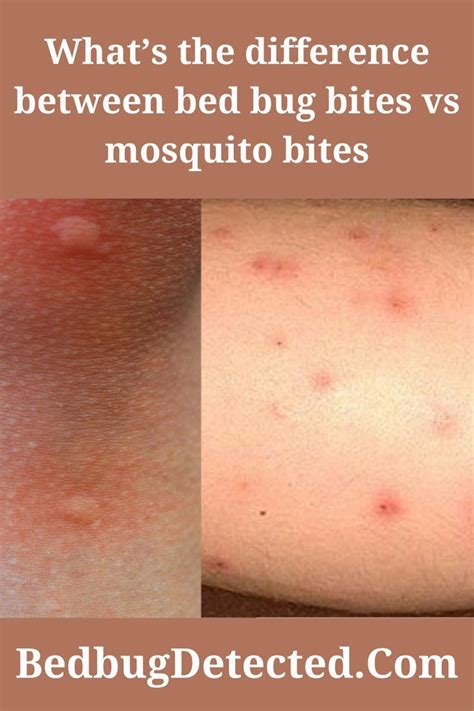 Difference Between Bed Bug Bites Vs Mosquito Bites In 2022 Bed Bug Bites Bed Bugs Mosquito Bite