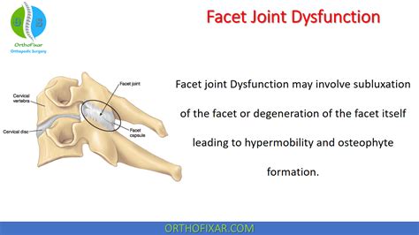 Facet Joint Dysfunction Orthofixar