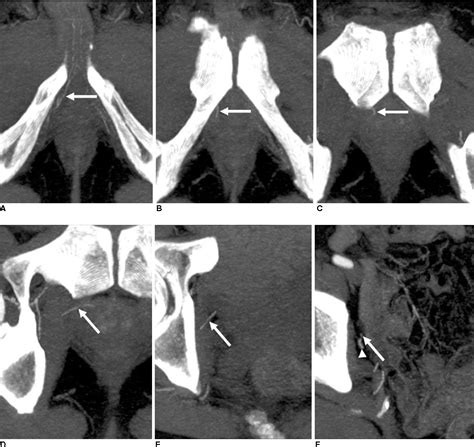 Structure of inferior vesical artery | Semantic Scholar