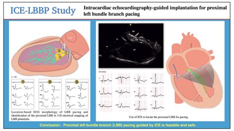 Intracardiac Echocardiographyguided Implantation For Proximal Left