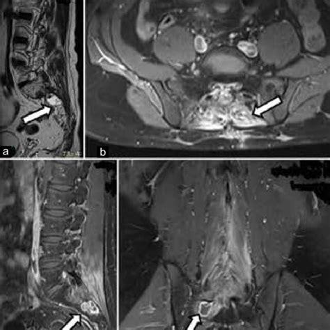 In The Postoperative Month A T Weighted Sagittal Magnetic